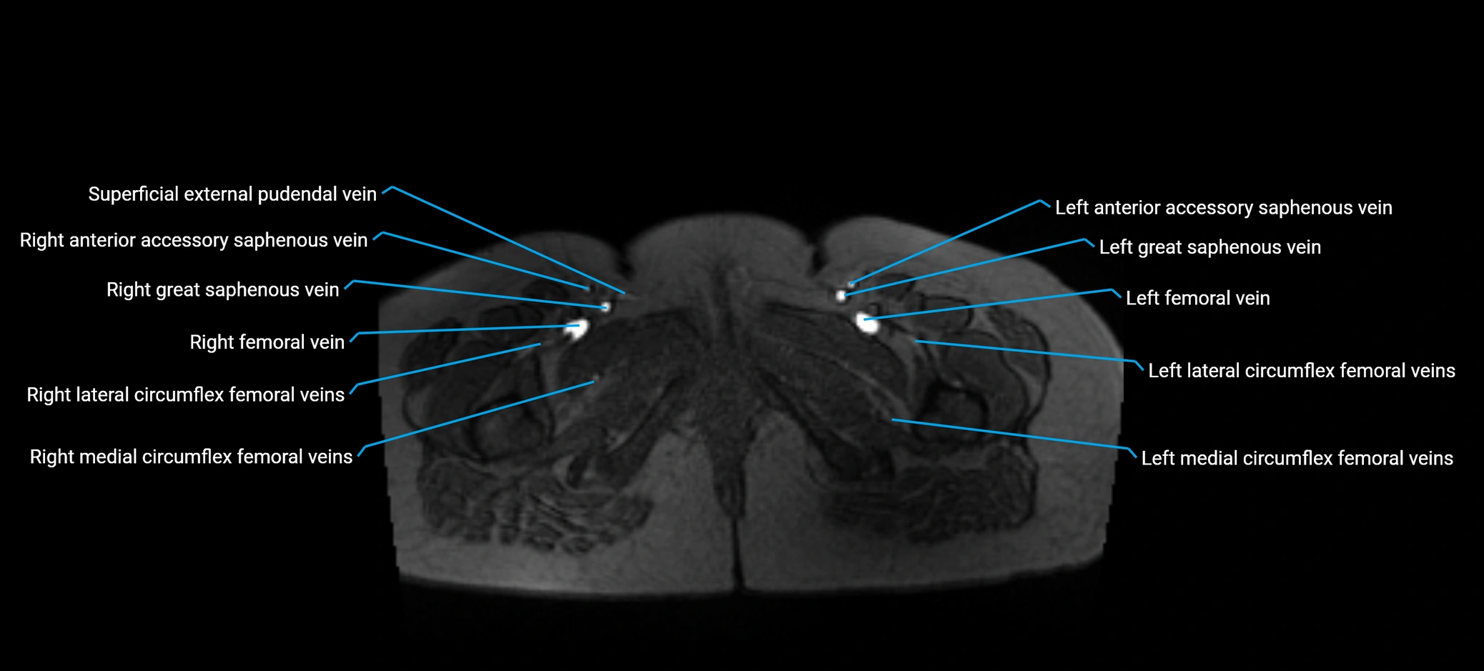 MRV abdomen pelvis & lower limb axial cross sectional anatomy labelled MRI image 202 (1).webp